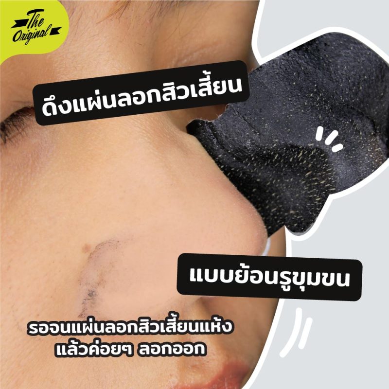 ลอกสิวเสี้ยนอย่างไรให้หลุดถอนราก-05